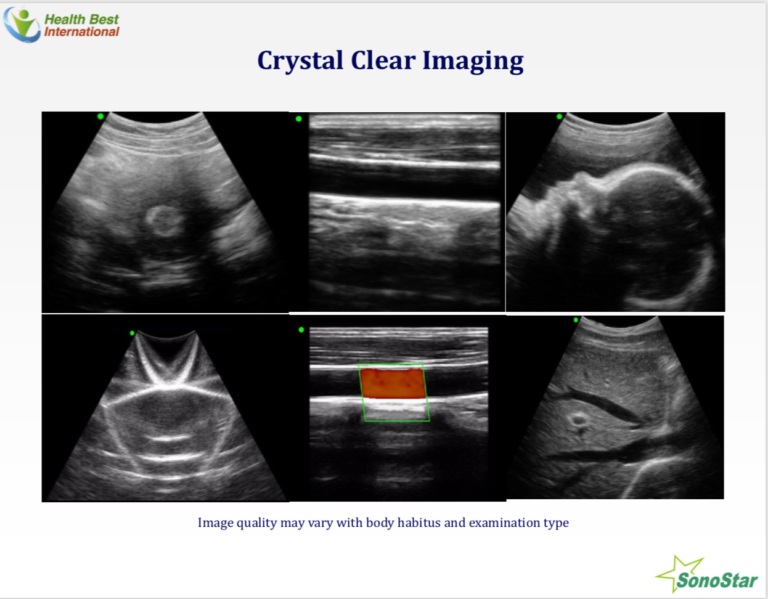 Hand-held, Wireless Ultrasound- Sonostar | ZG Worldwide